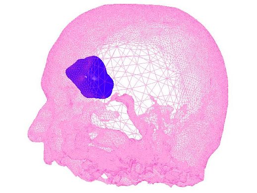 Tumor 3D